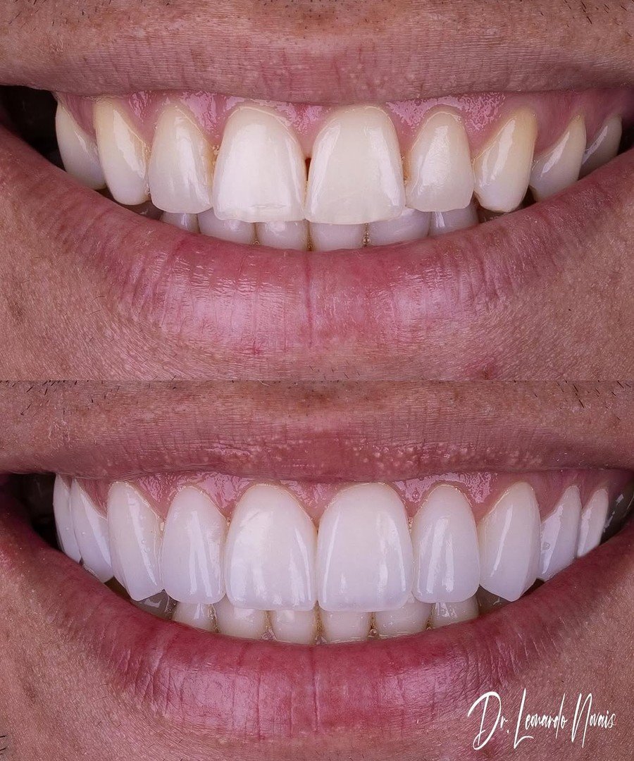 Antes e depois, caso 1