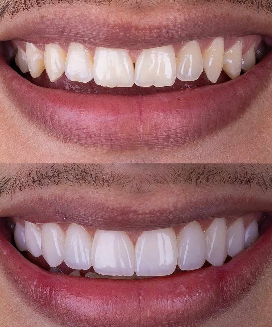 Antes e depois, caso 2
