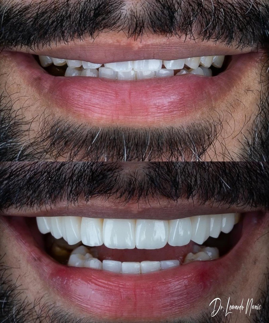 Antes e depois, caso 4